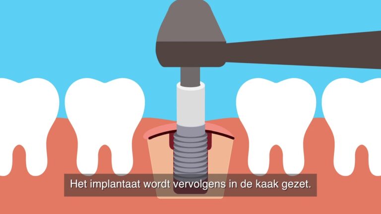 Tandimplantate in Sint-Niklaas: Ihre L&ouml;sungen f&uuml;r ein strahlendes L&auml;cheln
